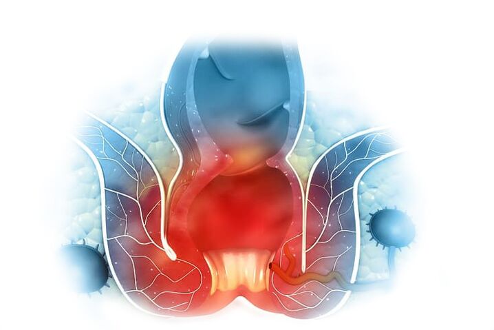 Tratamentul eficient al hemoroizilor interni și externi cu crema Proctonic